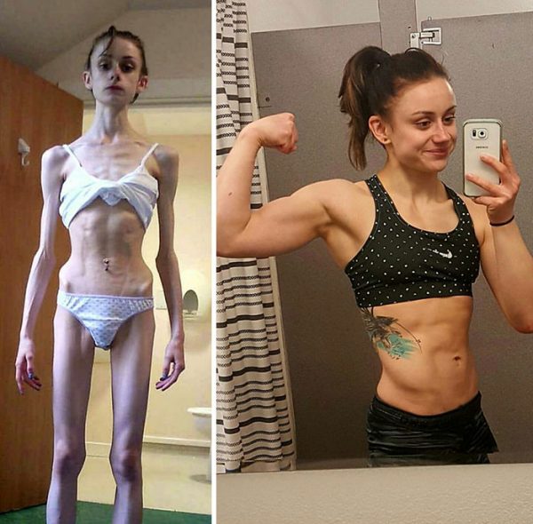 anorexia-recovery-before-after-101-58f5b1c3eb2c1__700