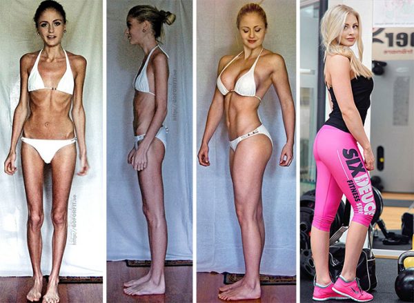 anorexia-recovery-before-after-111-58f60de428d6d__700