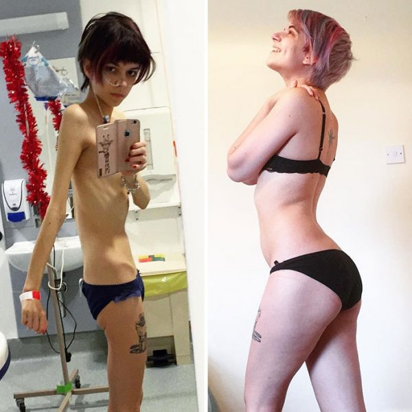 anorexia-recovery-before-after-118-58f61902e2172__700