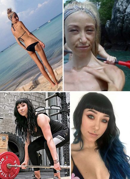 anorexia-recovery-before-after-129-58f71c96a236f__700