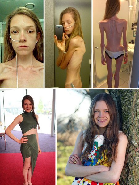 anorexia-recovery-before-after-130-58f7209c5d1f7__700