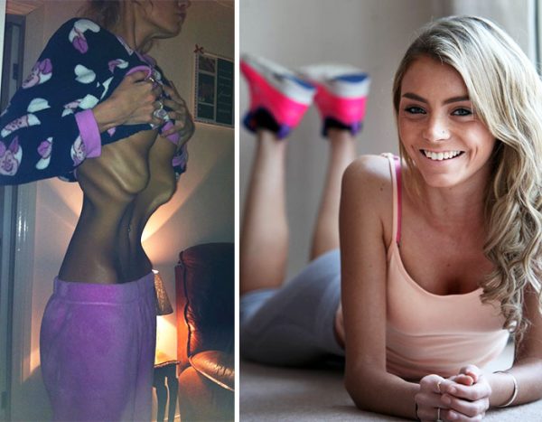 anorexia-recovery-before-after-214-590328556e51a__700