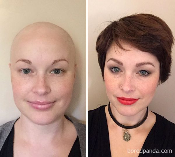 before-after-beating-cancer-17-5992c1517938a__700