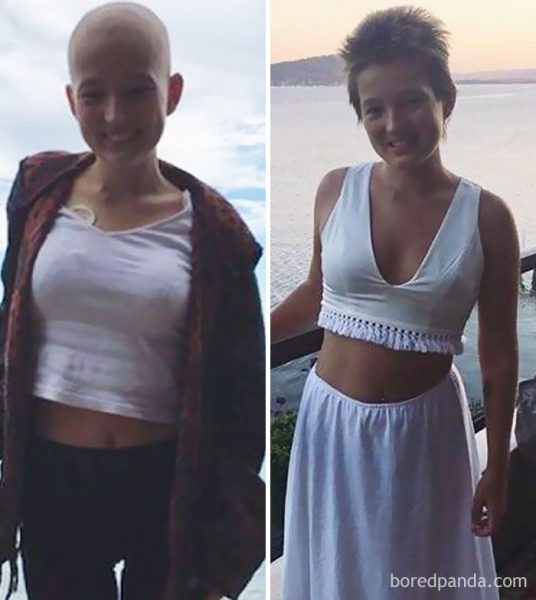 before-after-beating-cancer-2-5992a3ccbf45a__700