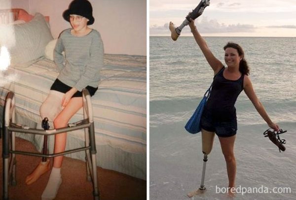 before-after-beating-cancer-3-5992a3ecc083f__700