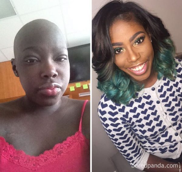 before-after-beating-cancer-301-599404ed45314__700