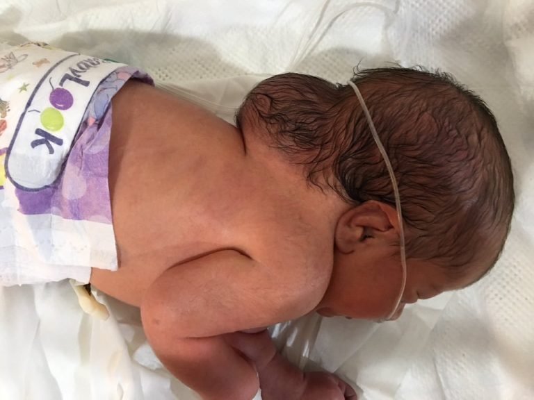 Irak�ta Doğum Kusurları Savaşın Etkileri Devam Ediyor