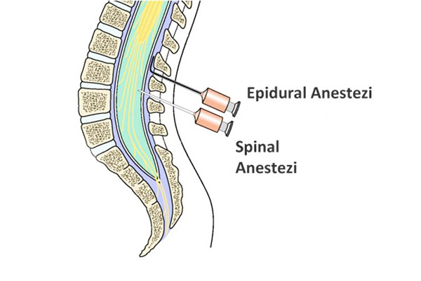 Epidural ve Spinal Anestezi Arasındaki Farklar 