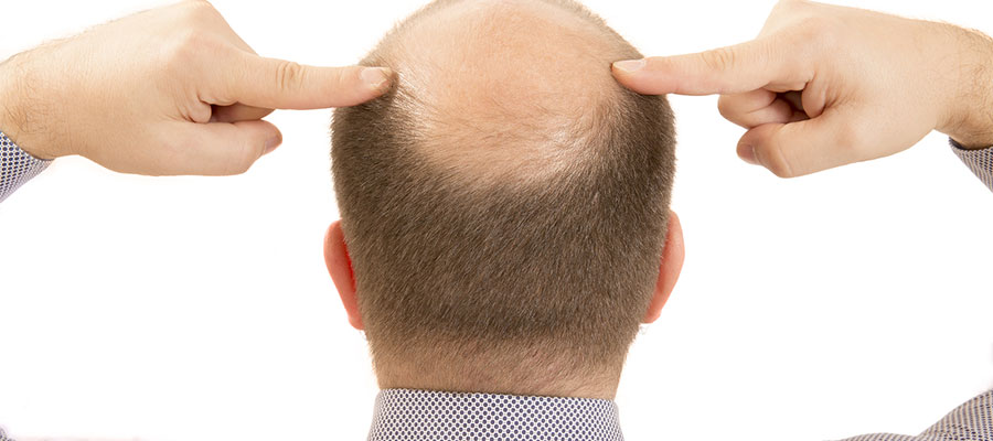 biotin eksikliği