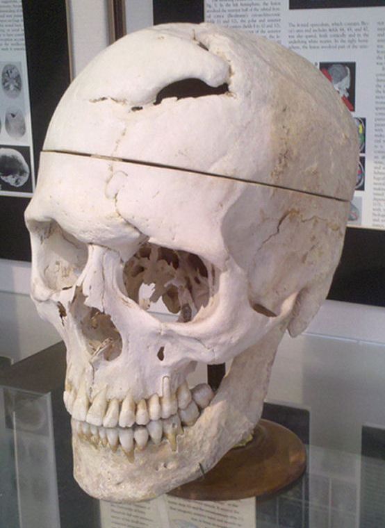 phineas gage